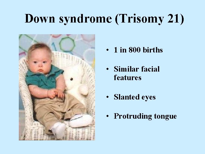 Down syndrome (Trisomy 21) • 1 in 800 births • Similar facial features •