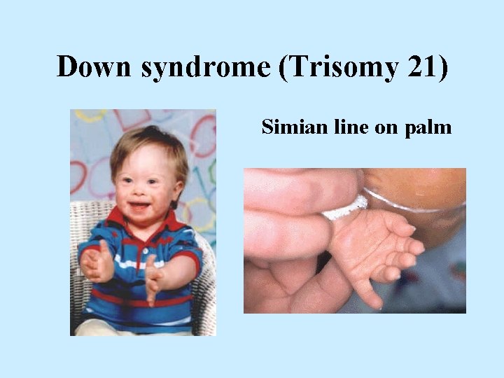Down syndrome (Trisomy 21) Simian line on palm 