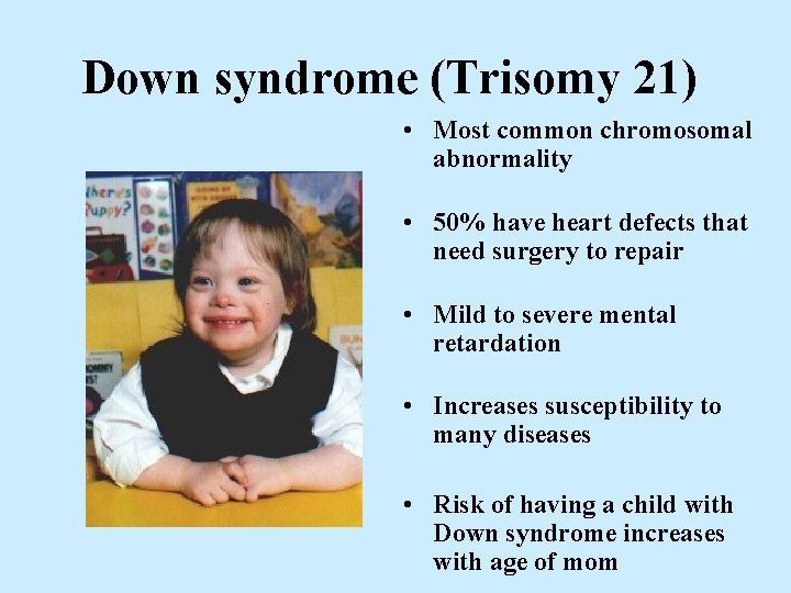 Down syndrome (Trisomy 21) • Most common chromosomal abnormality • 50% have heart defects