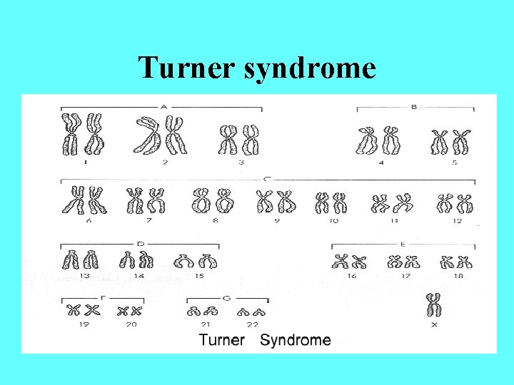Turner syndrome 