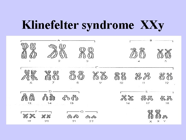 Klinefelter syndrome XXy 