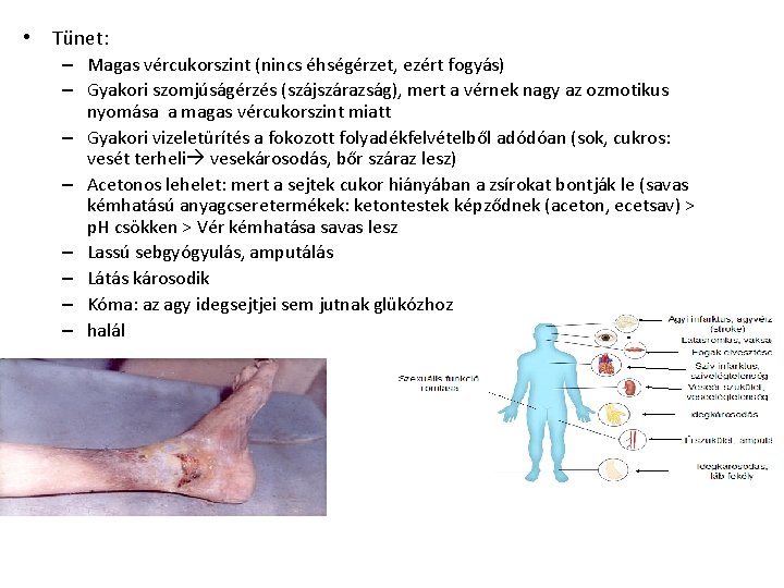 • Tünet: – Magas vércukorszint (nincs éhségérzet, ezért fogyás) – Gyakori szomjúságérzés (szájszárazság), • Tünet: – Magas vércukorszint (nincs éhségérzet, ezért fogyás) – Gyakori szomjúságérzés (szájszárazság),