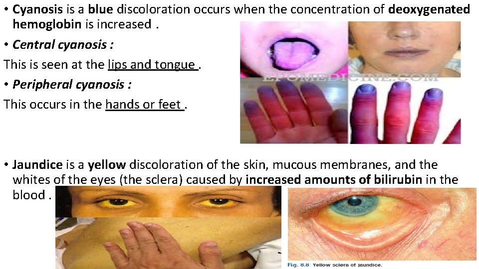  • Cyanosis is a blue discoloration occurs when the concentration of deoxygenated hemoglobin