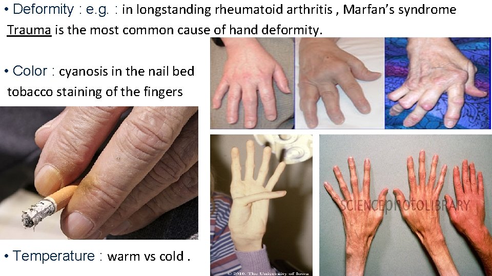  • Deformity : e. g. : in longstanding rheumatoid arthritis , Marfan’s syndrome