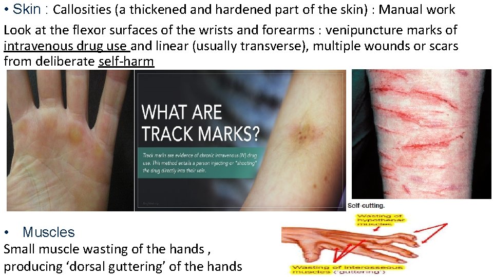  • Skin : Callosities (a thickened and hardened part of the skin) :