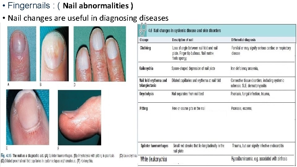  • Fingernails : ( Nail abnormalities ) • Nail changes are useful in