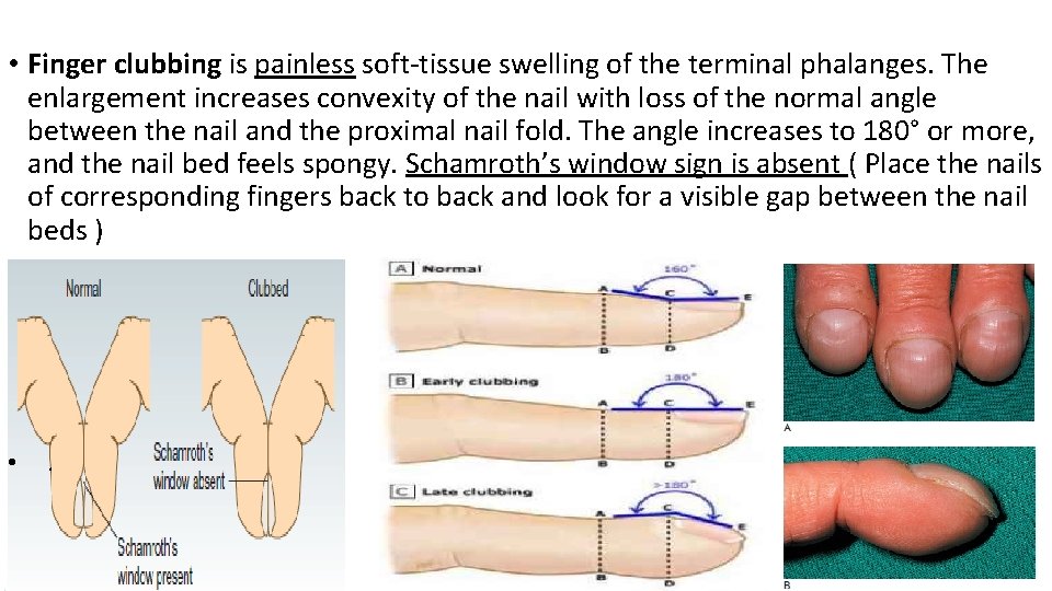  • Finger clubbing is painless soft-tissue swelling of the terminal phalanges. The enlargement