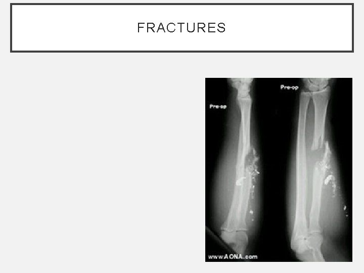 FRACTURES FRACTURES