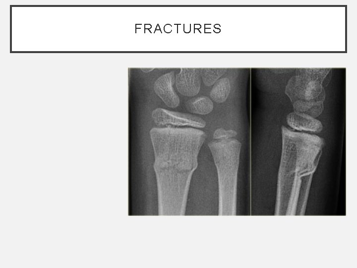 FRACTURES FRACTURES