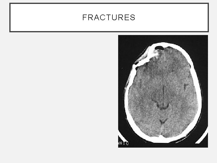 FRACTURES FRACTURES