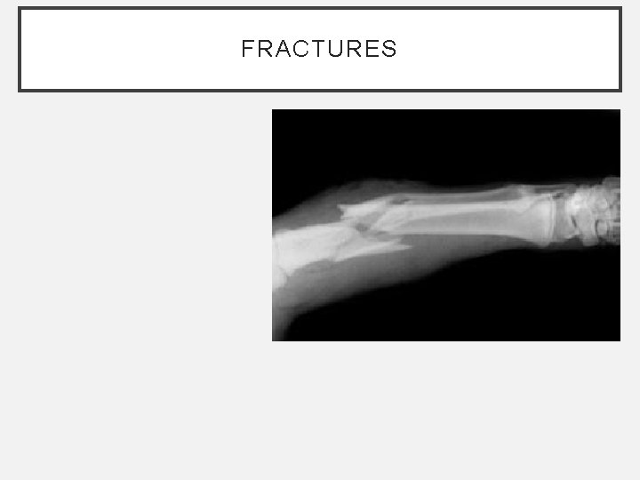 FRACTURES FRACTURES