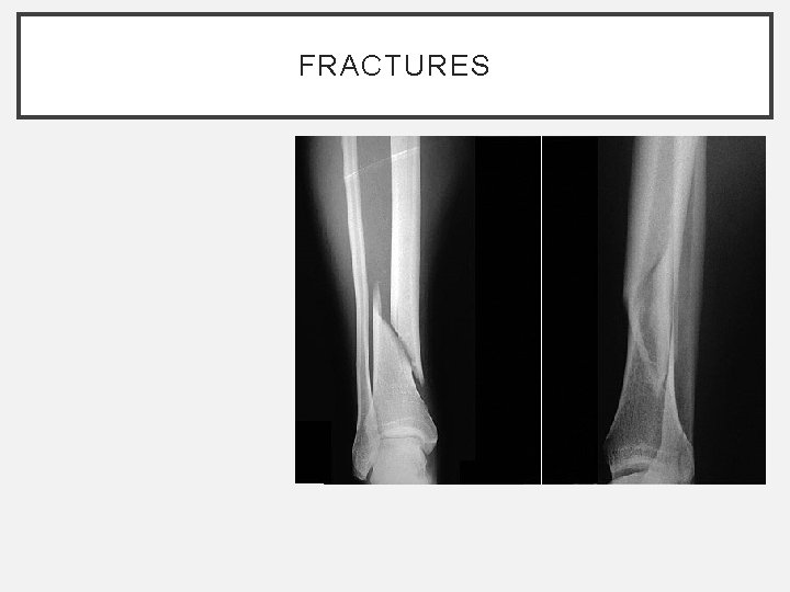 FRACTURES FRACTURES