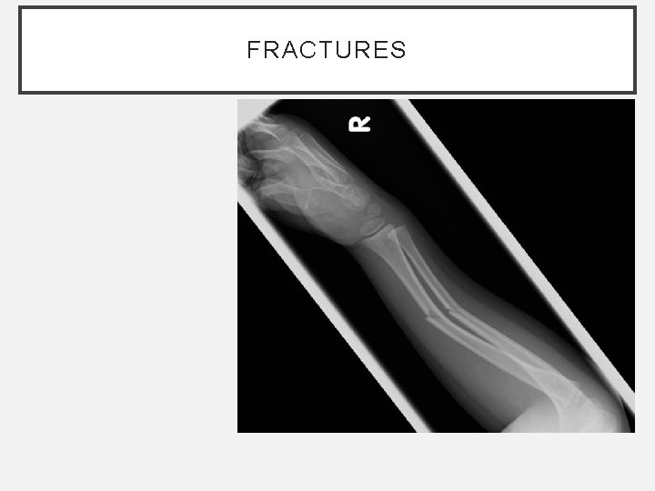 FRACTURES FRACTURES