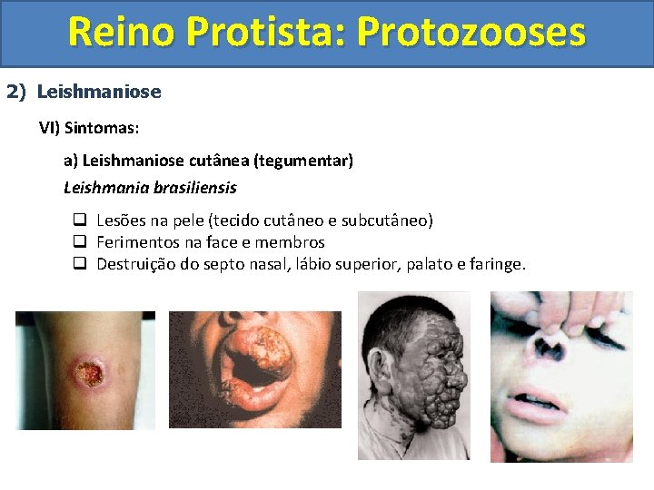 Reino Protista: Protozooses 2) Leishmaniose VI) Sintomas: a) Leishmaniose cutânea (tegumentar) Leishmania brasiliensis q