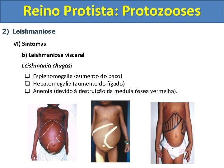 Reino Protista: Protozooses 2) Leishmaniose VI) Sintomas: b) Leishmaniose visceral Leishmania chagasi q Esplenomegalia