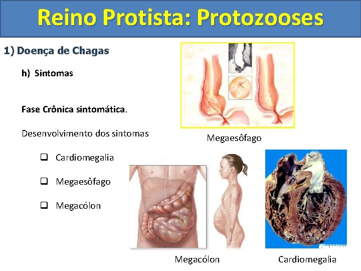 Reino Protista: Protozooses 1) Doença de Chagas h) Sintomas Fase Crônica sintomática. Desenvolvimento dos