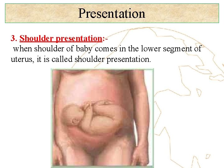 Presentation 3. Shoulder presentation: when shoulder of baby comes in the lower segment of