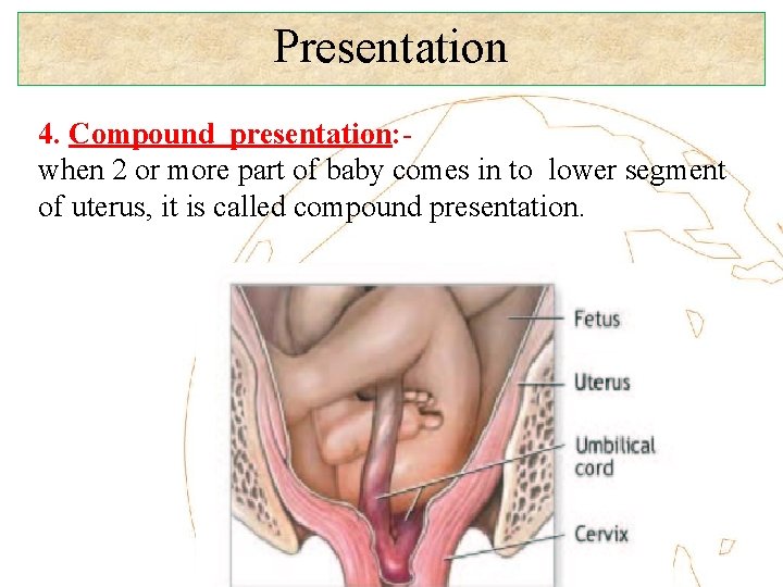 Presentation 4. Compound presentation: when 2 or more part of baby comes in to