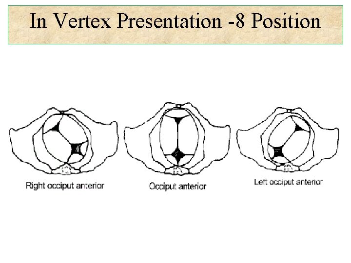 In Vertex Presentation -8 Position 
