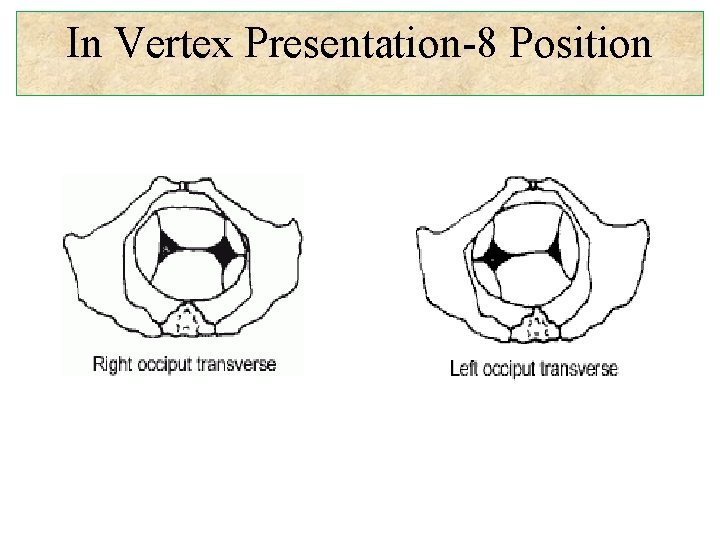 In Vertex Presentation-8 Position 