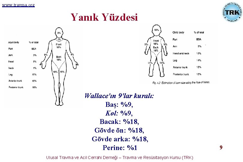 www. travma. org Yanık Yüzdesi Wallace'ın 9'lar kuralı: Baş: %9, Kol: %9, Bacak: %18, www. travma. org Yanık Yüzdesi Wallace'ın 9'lar kuralı: Baş: %9, Kol: %9, Bacak: %18,
