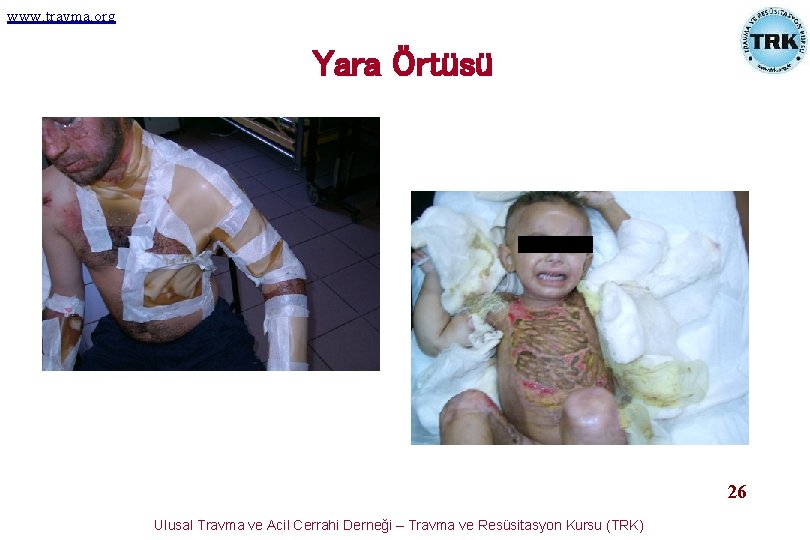www. travma. org Yara Örtüsü gggggg 26 Ulusal Travma ve Acil Cerrahi Derneği – www. travma. org Yara Örtüsü gggggg 26 Ulusal Travma ve Acil Cerrahi Derneği –
