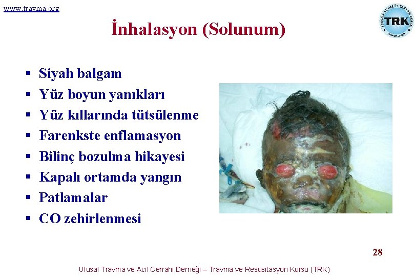 www. travma. org İnhalasyon (Solunum) § § § § Siyah balgam Yüz boyun yanıkları www. travma. org İnhalasyon (Solunum) § § § § Siyah balgam Yüz boyun yanıkları