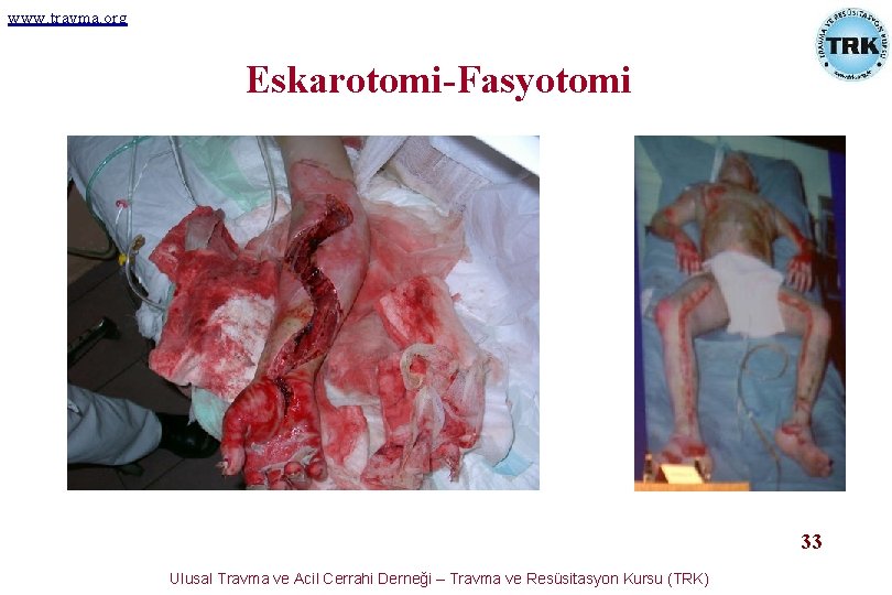 www. travma. org Eskarotomi-Fasyotomi 33 Ulusal Travma ve Acil Cerrahi Derneği – Travma ve www. travma. org Eskarotomi-Fasyotomi 33 Ulusal Travma ve Acil Cerrahi Derneği – Travma ve