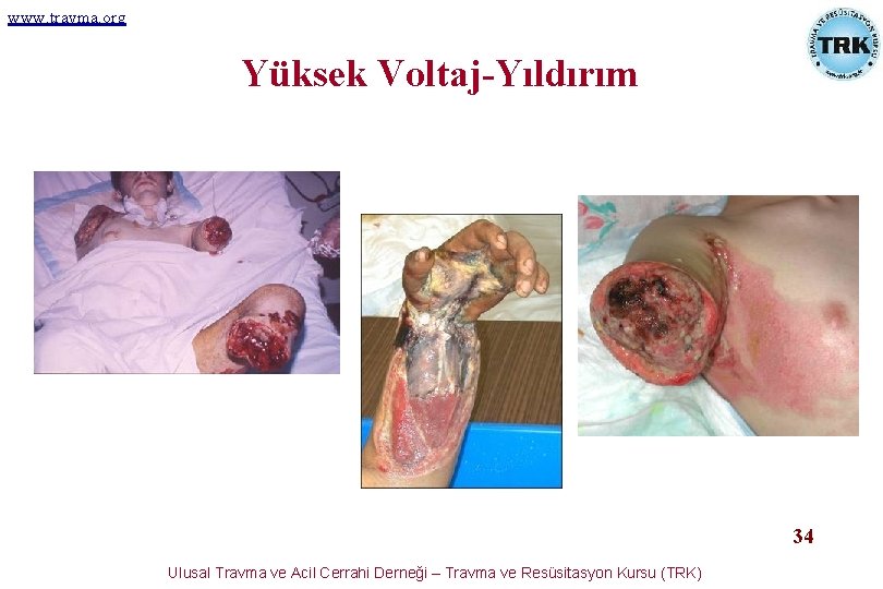 www. travma. org Yüksek Voltaj-Yıldırım 34 Ulusal Travma ve Acil Cerrahi Derneği – Travma www. travma. org Yüksek Voltaj-Yıldırım 34 Ulusal Travma ve Acil Cerrahi Derneği – Travma