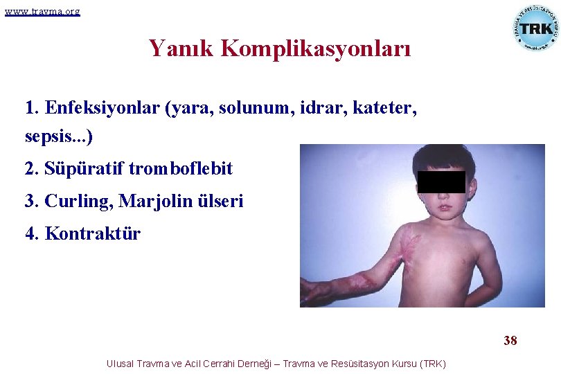 www. travma. org Yanık Komplikasyonları 1. Enfeksiyonlar (yara, solunum, idrar, kateter, sepsis. . . www. travma. org Yanık Komplikasyonları 1. Enfeksiyonlar (yara, solunum, idrar, kateter, sepsis. . .