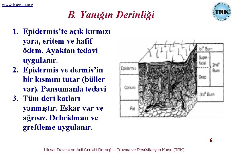 www. travma. org B. Yanığın Derinliği 1. Epidermis’te açık kırmızı yara, eritem ve hafif www. travma. org B. Yanığın Derinliği 1. Epidermis’te açık kırmızı yara, eritem ve hafif