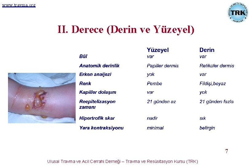 www. travma. org II. Derece (Derin ve Yüzeyel) 7 Ulusal Travma ve Acil Cerrahi www. travma. org II. Derece (Derin ve Yüzeyel) 7 Ulusal Travma ve Acil Cerrahi