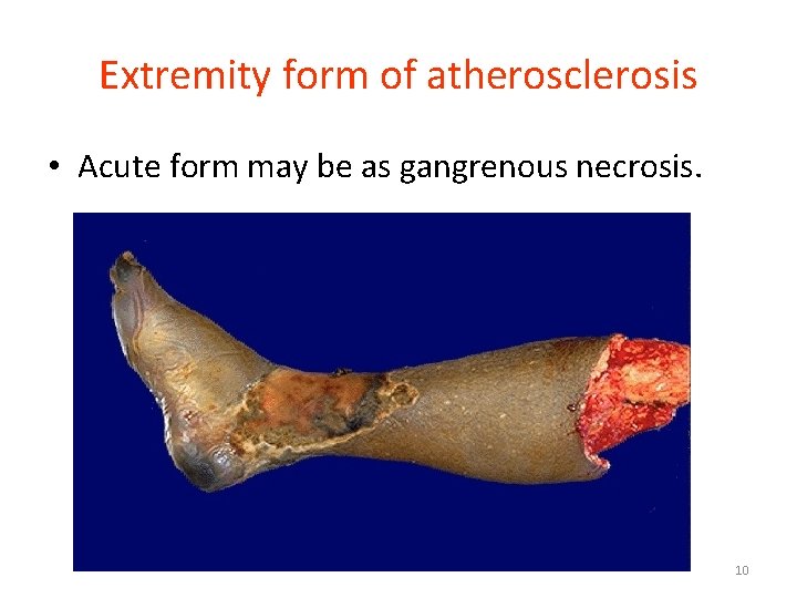 Extremity form of atherosclerosis • Acute form may be as gangrenous necrosis. 10 Extremity form of atherosclerosis • Acute form may be as gangrenous necrosis. 10