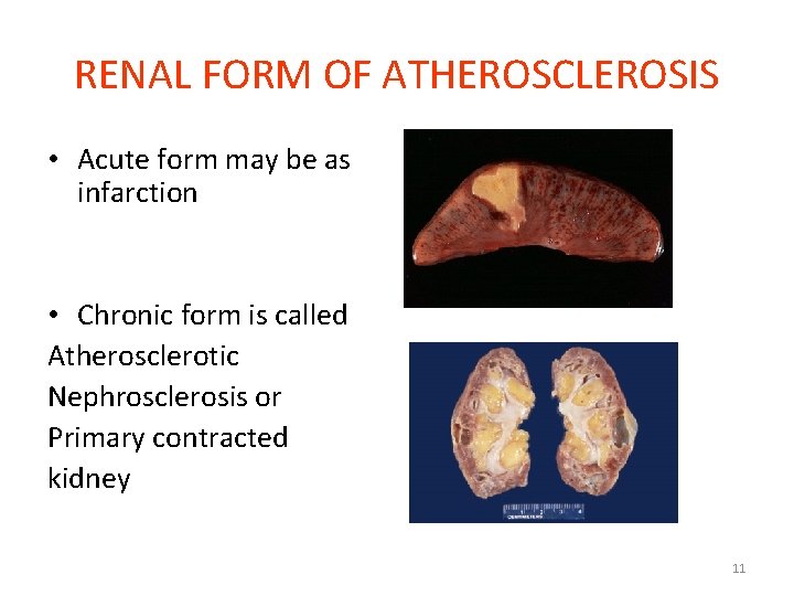 RENAL FORM OF ATHEROSCLEROSIS • Acute form may be as infarction • Chronic form