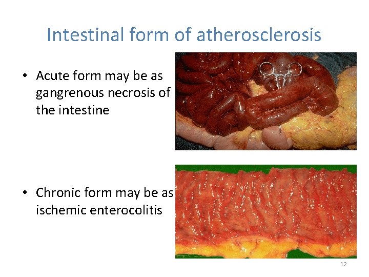 Intestinal form of atherosclerosis • Acute form may be as gangrenous necrosis of the