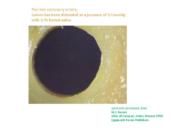 Normal coronary artery Lumen has been distended at a pressure of 100 mm. Hg