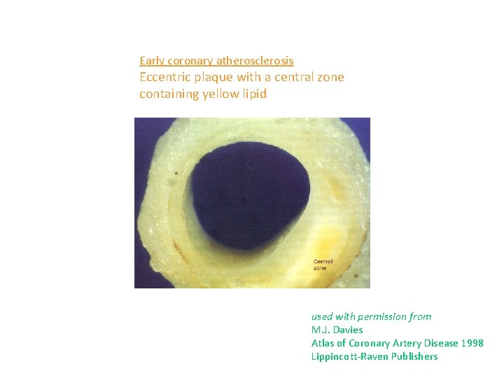 Early coronary atherosclerosis Eccentric plaque with a central zone containing yellow lipid used with