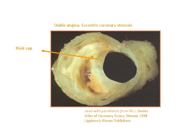 Stable angina. Eccentric coronary stenosis thick cap used with permission from M. J. Davies