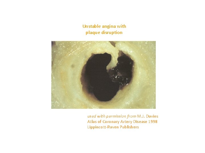 Unstable angina with plaque disruption used with permission from M. J. Davies Atlas of
