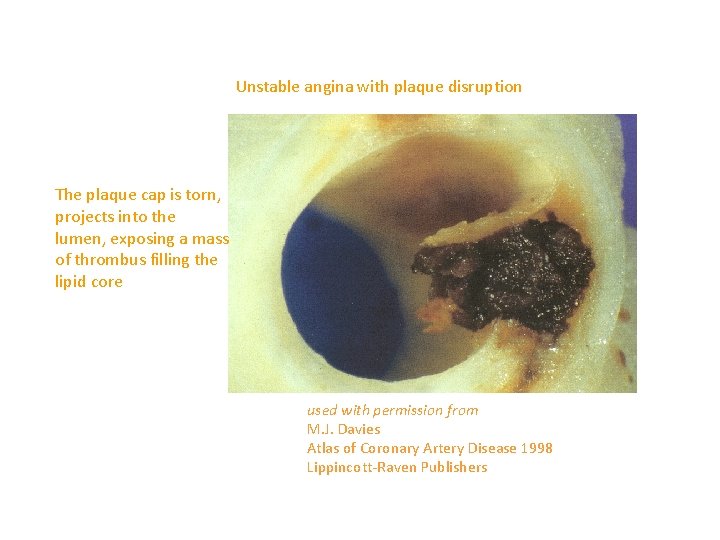 Unstable angina with plaque disruption The plaque cap is torn, projects into the lumen, Unstable angina with plaque disruption The plaque cap is torn, projects into the lumen,