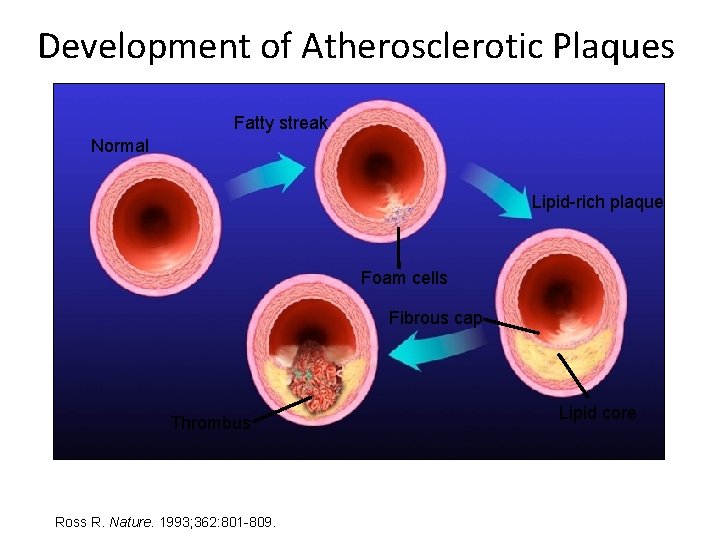 Development of Atherosclerotic Plaques Fatty streak Normal Lipid-rich plaque Foam cells Fibrous cap Thrombus