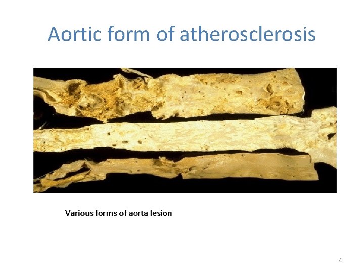 Aortic form of atherosclerosis Various forms of aorta lesion 4 