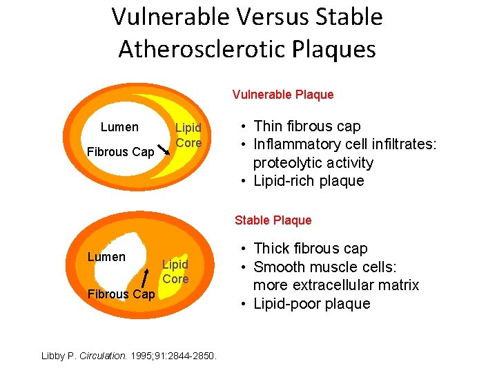 Vulnerable Versus Stable Atherosclerotic Plaques Vulnerable Plaque Lumen Fibrous Cap Lipid Core • Thin