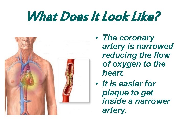 What Does It Look Like? • The coronary artery is narrowed reducing the flow