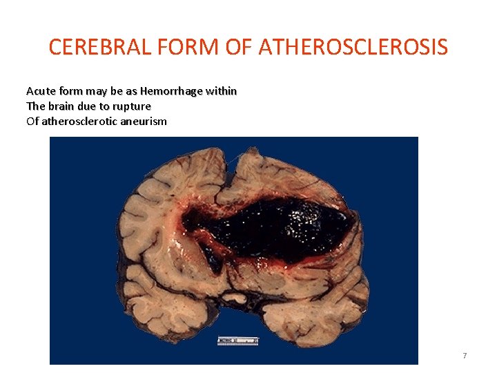 CEREBRAL FORM OF ATHEROSCLEROSIS Acute form may be as Hemorrhage within The brain due