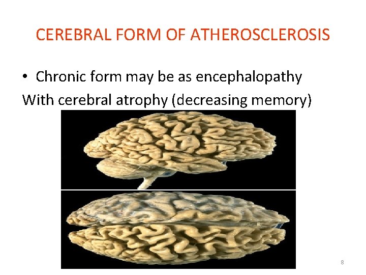 CEREBRAL FORM OF ATHEROSCLEROSIS • Chronic form may be as encephalopathy With cerebral atrophy