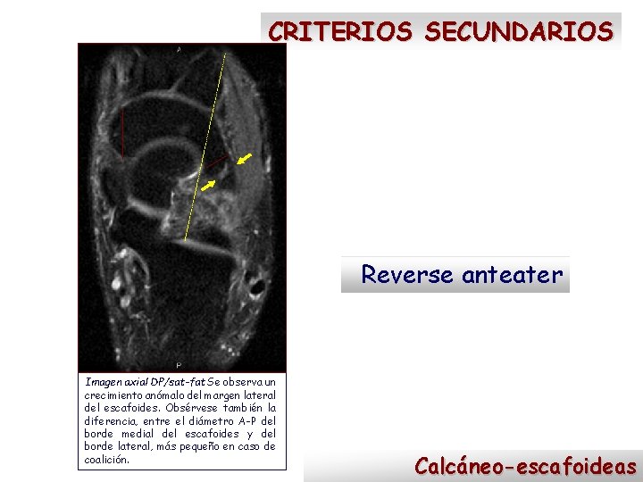 CRITERIOS SECUNDARIOS Reverse anteater Imagen axial DP/sat-fat Se observa un crecimiento anómalo del margen