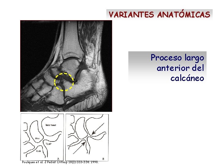 VARIANTES ANATÓMICAS Proceso largo anterior del calcáneo Pouliquen et al. J Pediat Orthop 18(3):