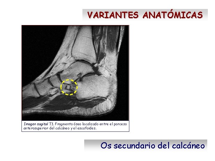 VARIANTES ANATÓMICAS Imagen sagital T 1. Fragmento óseo localizado entre el porceso anterosuperior del