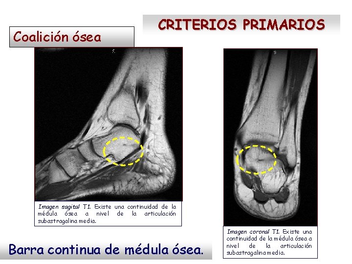 Coalición ósea CRITERIOS PRIMARIOS Imagen sagital T 1. Existe una continuidad de la médula